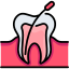 Root Canal