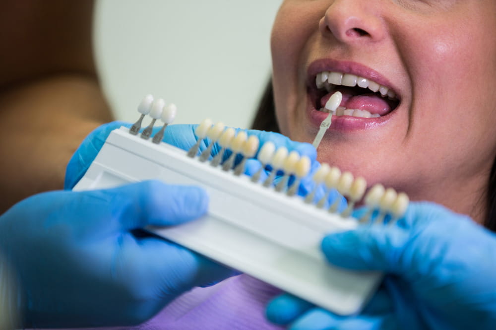 Dental Veneers