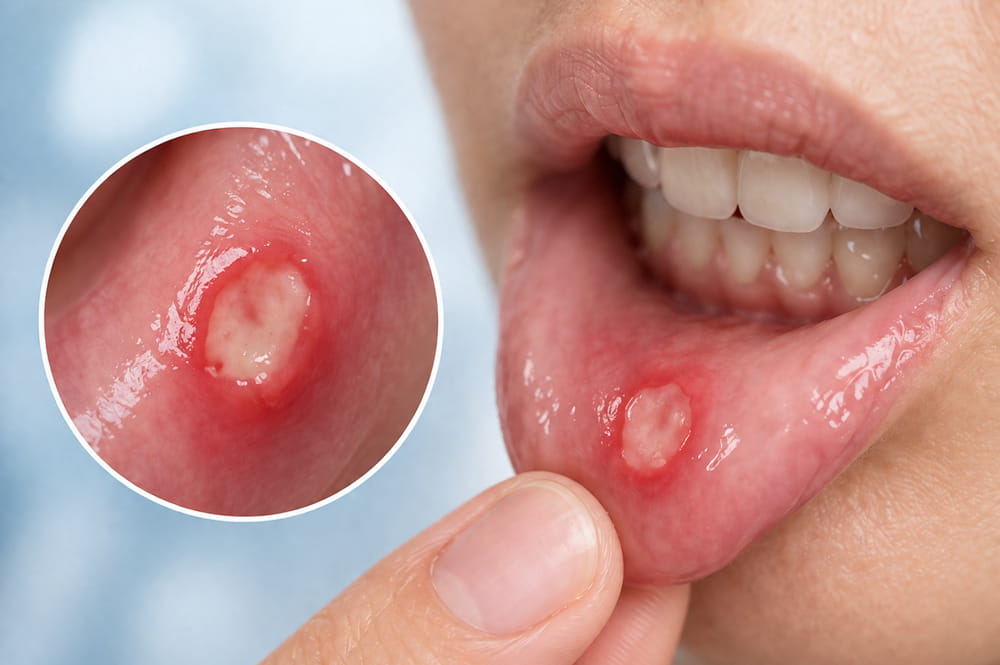 Mouth Ulcers